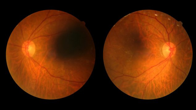 Investigan tratamiento contra la retinitis pigmentosa